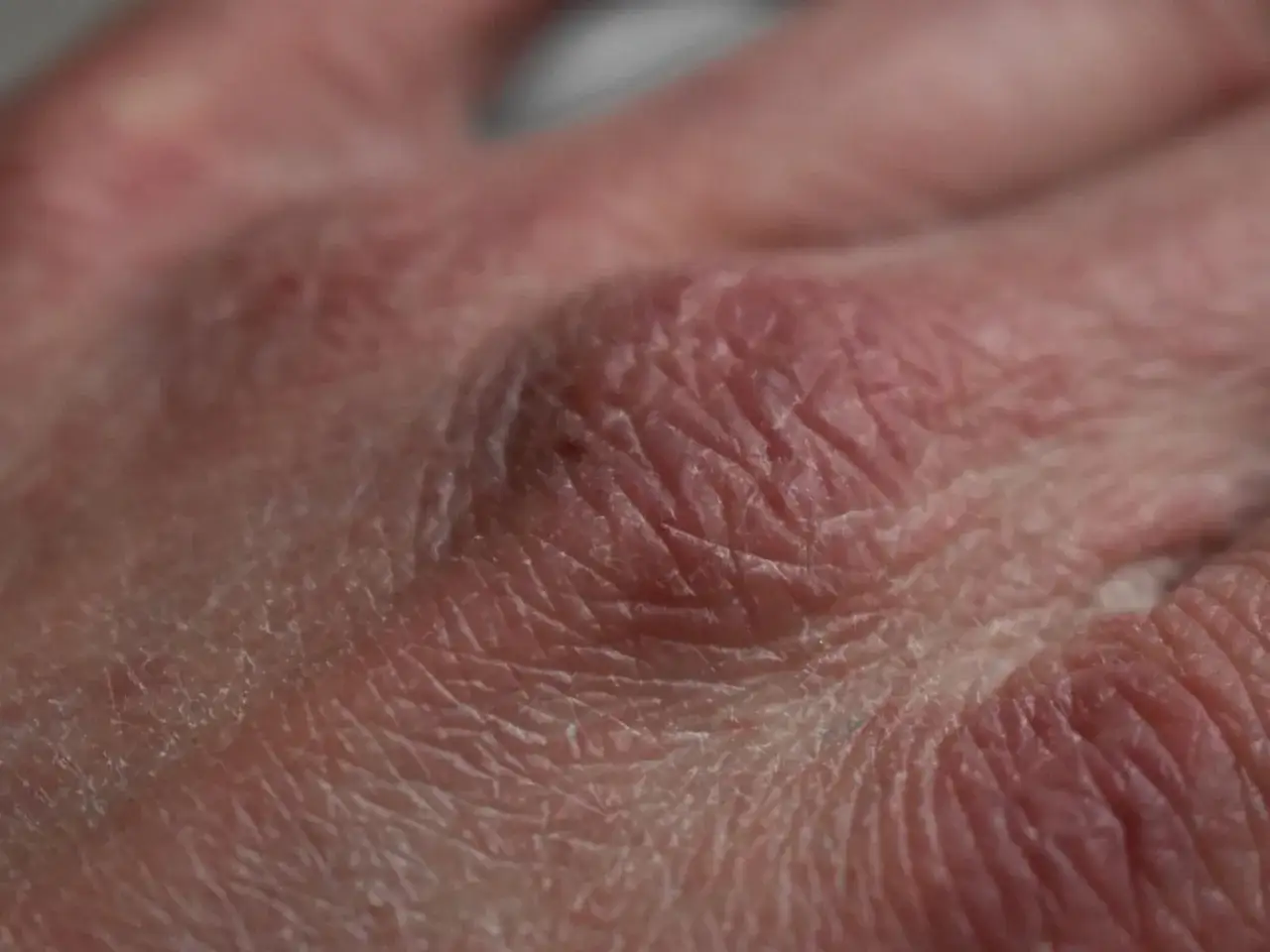 Närbild på torr, sprucken hud på en hand. Kan vara ett tecken på d-vitaminbrist hudproblem.