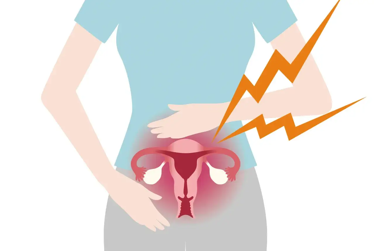 Illustration av en kvinna som h&aring;ller sig om magen, med en illustration av livmodern och &auml;ggstockarna som visar sm&auml;rta. Blixtar indikerar sv&aring;ra endometrios symtom.